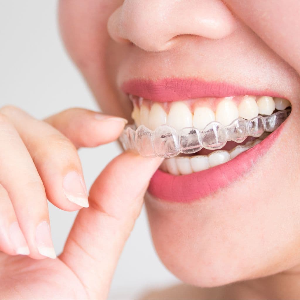 ¿Qué es Invisalign?